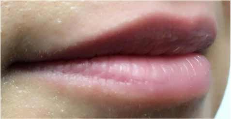 Juvederm Before & After Patient #11337