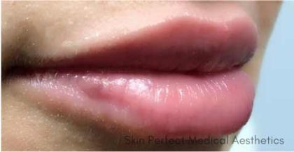 Juvederm Before & After Patient #11337
