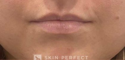 Botox, Dysport, & Xeomin Before & After Patient #11338