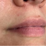 Botox, Dysport, & Xeomin Before & After Patient #11340