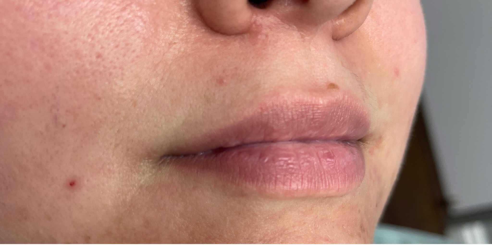 Botox, Dysport, & Xeomin Before & After Patient #11340