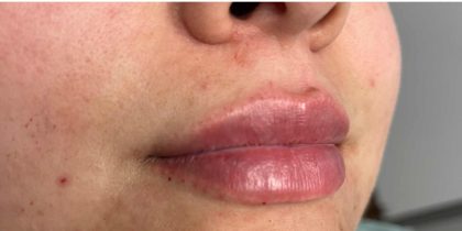 Botox, Dysport, & Xeomin Before & After Patient #11340