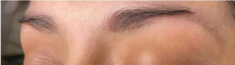 Microneedling Before & After Patient #11342
