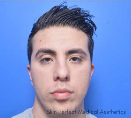 Microneedling Before & After Patient #11343