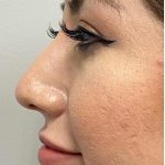 Non-surgical Nose Job Before & After Patient #11344