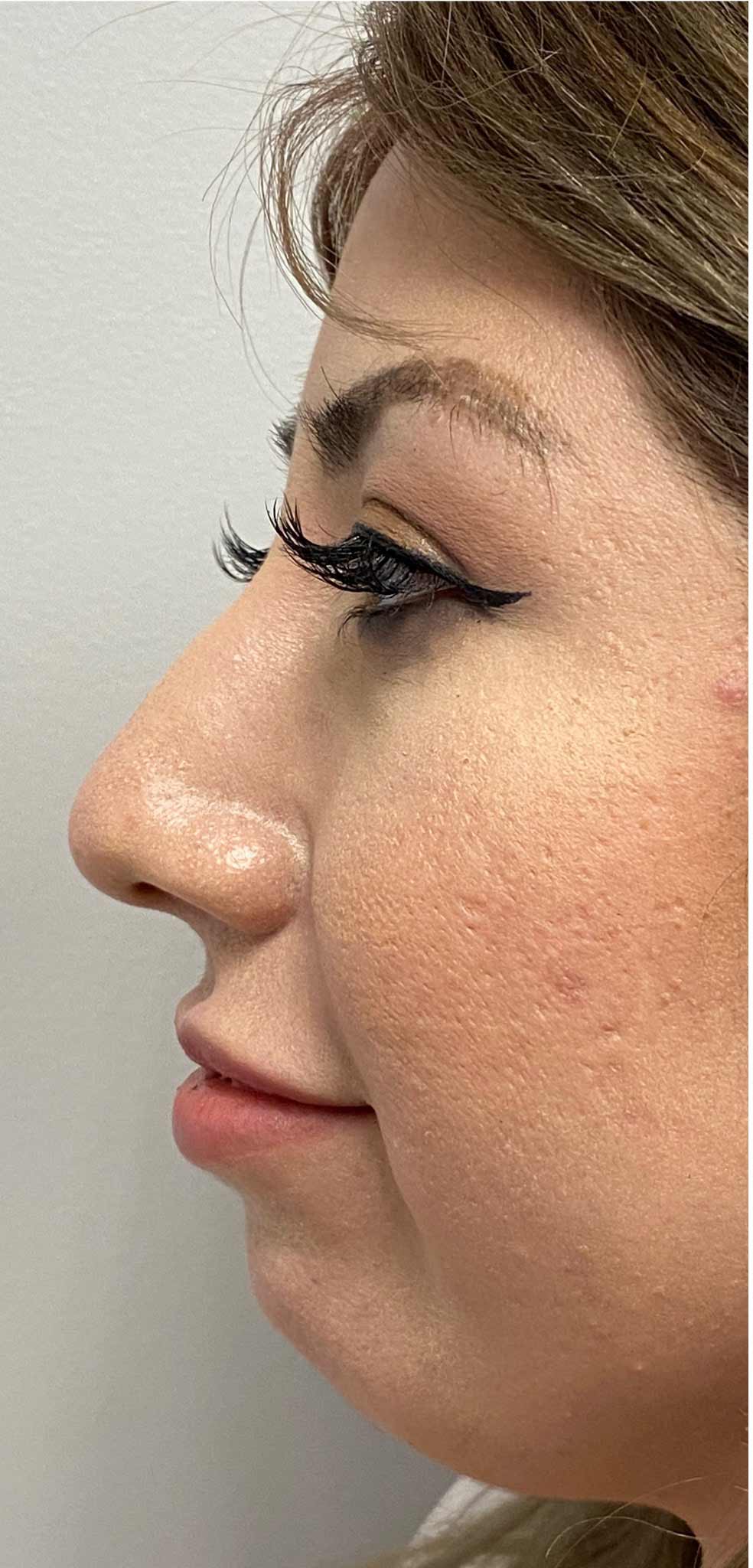 Non-surgical Nose Job Before & After Patient #11344
