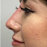 Non-surgical Nose Job Before & After Patient #11344