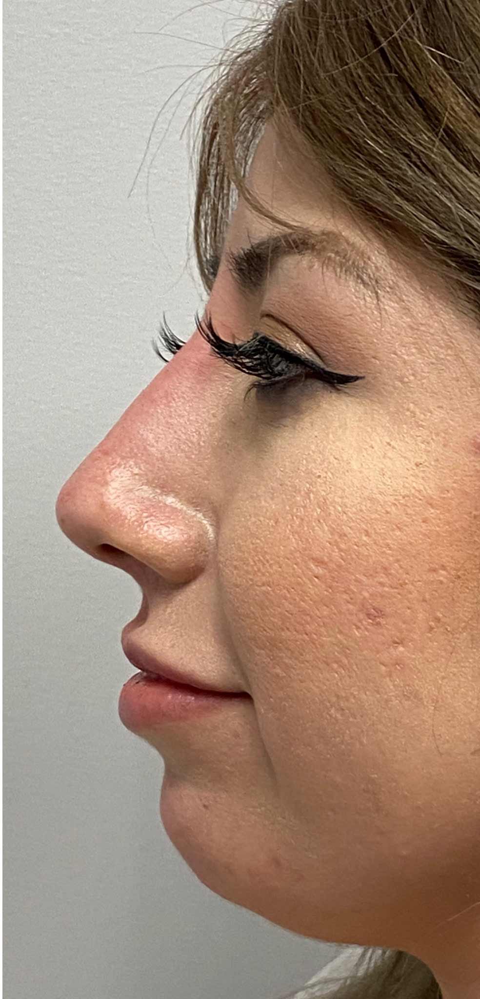 Non-surgical Nose Job Before & After Patient #11344