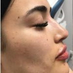 Chin Filler Before & After Patient #11345