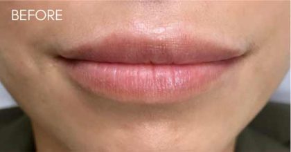 Botox, Dysport, & Xeomin Before & After Patient #11323