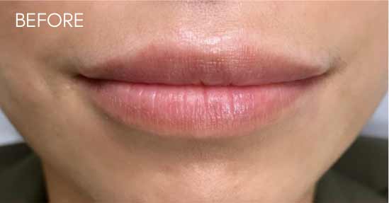 Botox, Dysport, & Xeomin Before & After Patient #11323