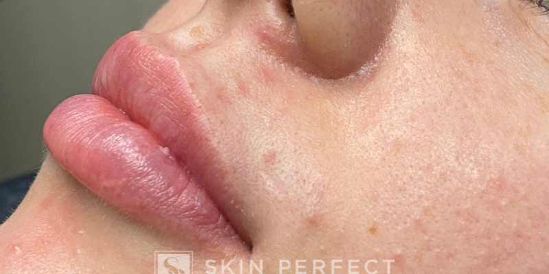 Botox, Dysport, & Xeomin Before & After Patient #11325