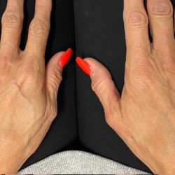 Hand Rejuventation Before & After Patient #12045