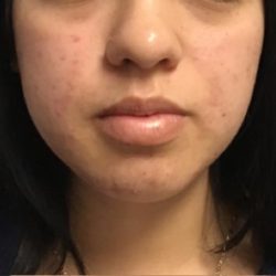Acne + Pigmentation Correction Before & After Patient #12038