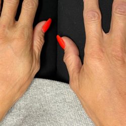 Hand Rejuventation Before & After Patient #12045