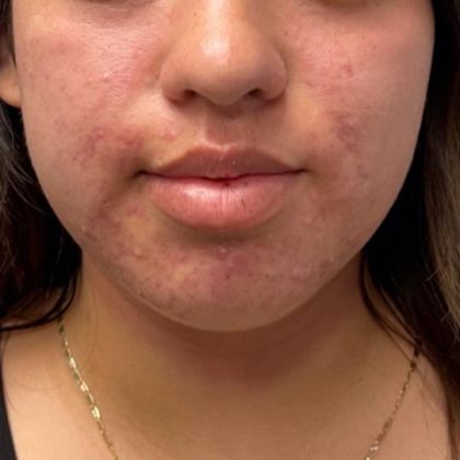 Acne + Pigmentation Correction Before & After Patient #12038