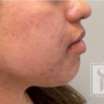 Acne + Pigmentation Correction Before & After Patient #12038
