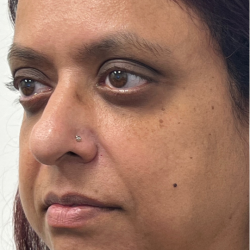 Lip Enhancement Before & After Patient #11958