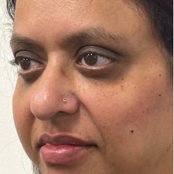 Lip Enhancement Before & After Patient #11958