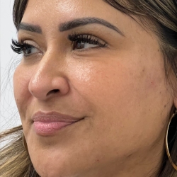 Cheek Enhancement Before & After Patient #12010