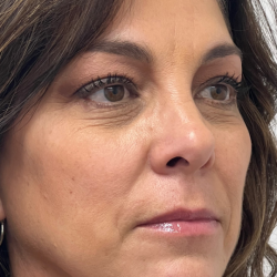 Non-Surgical Facelift Before & After Patient #11977