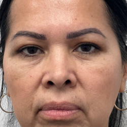 Lip Enhancement Before & After Patient #11959