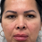Chin Enhancement Before & After Patient #12021