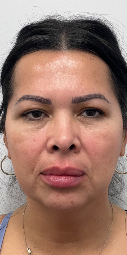 Chin Enhancement Before & After Patient #12021