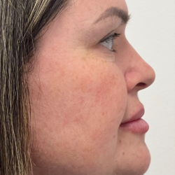 Chin Enhancement Before & After Patient #12022