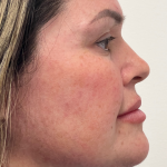 Chin Enhancement Before & After Patient #12022