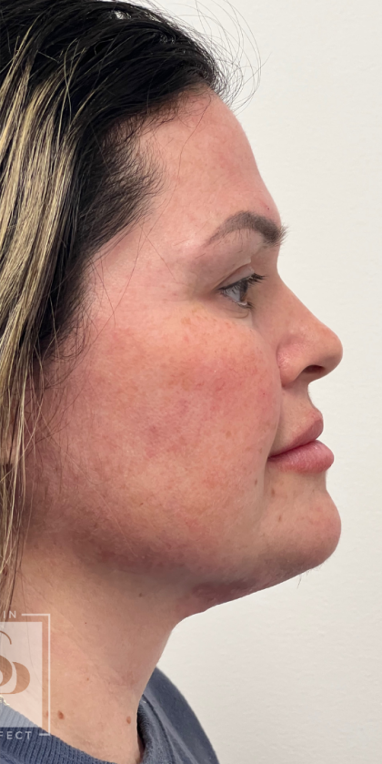 Chin Enhancement Before & After Patient #12022