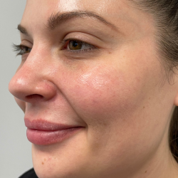 Wrinkle Reduction Before & After Patient #11956
