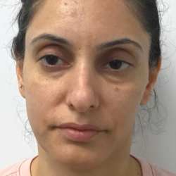 Acne + Pigmentation Correction Before & After Patient #12036