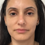Acne + Pigmentation Correction Before & After Patient #12036