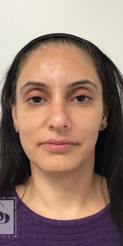 Acne + Pigmentation Correction Before & After Patient #12036