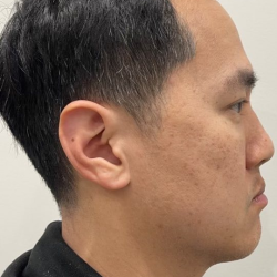 Jawline Enhancement Before & After Patient #12029