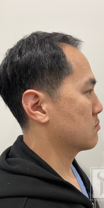 Jawline Enhancement Before & After Patient #12029