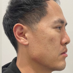 Jawline Enhancement Before & After Patient #12029