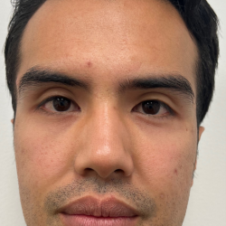 Jawline Enhancement Before & After Patient #12030