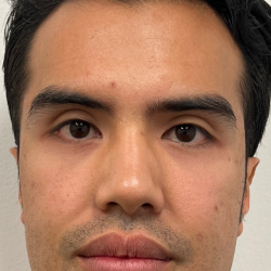 Jawline Enhancement Before & After Patient #12030