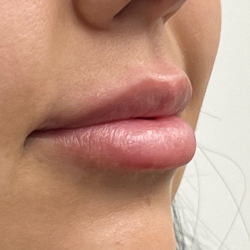 Lip Enhancement Before & After Patient #11968