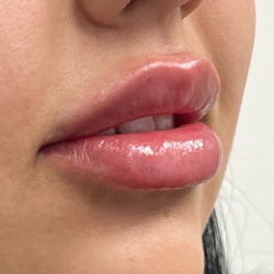 Lip Enhancement Before & After Patient #11968