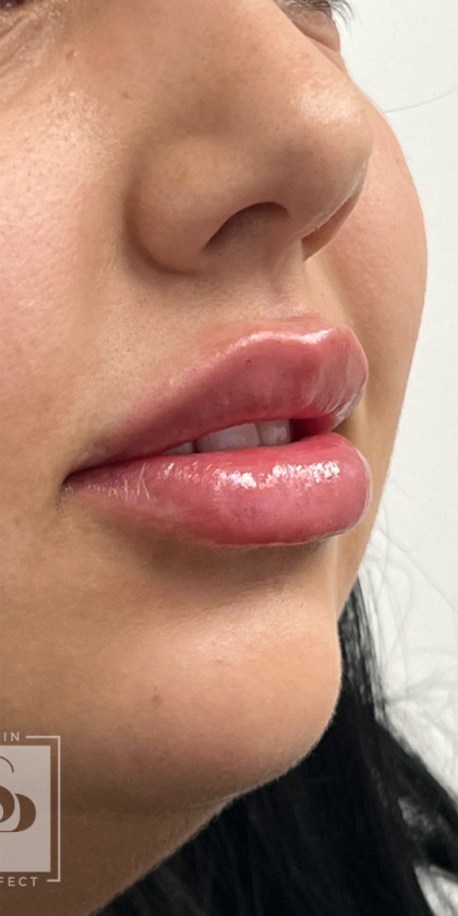 Lip Enhancement Before & After Patient #11968