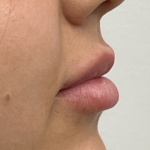 Lip Enhancement Before & After Patient #11968