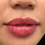 Lip Enhancement Before & After Patient #11969