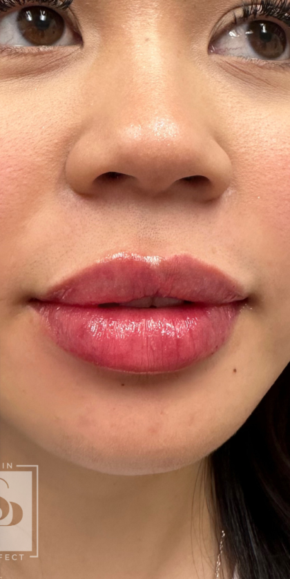 Lip Enhancement Before & After Patient #11969
