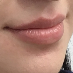 Lip Enhancement Before & After Patient #11970
