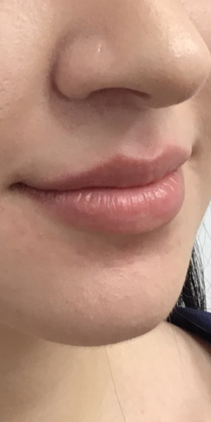 Lip Enhancement Before & After Patient #11970
