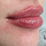 Lip Enhancement Before & After Patient #11970