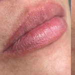 Lip Enhancement Before & After Patient #11971